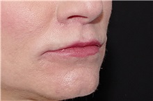 Lip Augmentation/Enhancement After Photo by Landon Pryor, MD, FACS; Rockford, IL - Case 38228