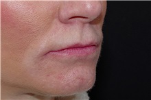 Lip Augmentation/Enhancement Before Photo by Landon Pryor, MD, FACS; Rockford, IL - Case 38228