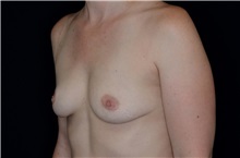 Breast Augmentation Before Photo by Landon Pryor, MD, FACS; Rockford, IL - Case 38229