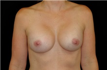 Breast Augmentation After Photo by Landon Pryor, MD, FACS; Rockford, IL - Case 38229