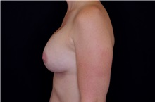 Breast Augmentation After Photo by Landon Pryor, MD, FACS; Rockford, IL - Case 38229