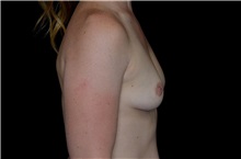 Breast Augmentation Before Photo by Landon Pryor, MD, FACS; Rockford, IL - Case 38229