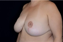 Breast Reduction After Photo by Landon Pryor, MD, FACS; Rockford, IL - Case 38231
