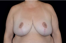Breast Reduction After Photo by Landon Pryor, MD, FACS; Rockford, IL - Case 38231