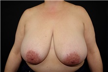 Breast Reduction Before Photo by Landon Pryor, MD, FACS; Rockford, IL - Case 38231