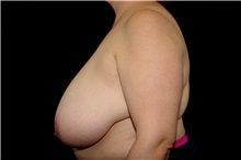 Breast Reduction Before Photo by Landon Pryor, MD, FACS; Rockford, IL - Case 38231