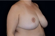 Liposuction After Photo by Landon Pryor, MD, FACS; Rockford, IL - Case 38232