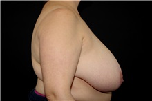 Liposuction Before Photo by Landon Pryor, MD, FACS; Rockford, IL - Case 38232