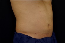 Liposuction After Photo by Landon Pryor, MD, FACS; Rockford, IL - Case 38520