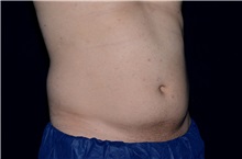 Liposuction Before Photo by Landon Pryor, MD, FACS; Rockford, IL - Case 38520