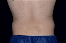 Liposuction Before Photo by Landon Pryor, MD, FACS; Rockford, IL - Case 38520