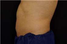 Liposuction After Photo by Landon Pryor, MD, FACS; Rockford, IL - Case 38520