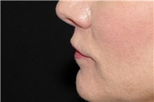 Lip Augmentation/Enhancement After Photo by Landon Pryor, MD, FACS; Rockford, IL - Case 38522