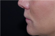 Lip Augmentation/Enhancement Before Photo by Landon Pryor, MD, FACS; Rockford, IL - Case 38522