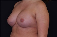 Breast Augmentation After Photo by Landon Pryor, MD, FACS; Rockford, IL - Case 38524