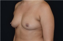 Breast Augmentation Before Photo by Landon Pryor, MD, FACS; Rockford, IL - Case 38524