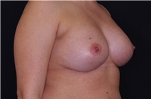Breast Augmentation After Photo by Landon Pryor, MD, FACS; Rockford, IL - Case 38524