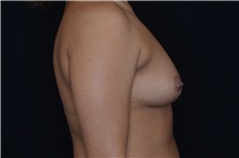 Breast Augmentation Before Photo by Landon Pryor, MD, FACS; Rockford, IL - Case 38524