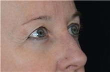 Eyelid Surgery Before Photo by Landon Pryor, MD, FACS; Rockford, IL - Case 38529
