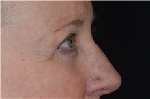 Eyelid Surgery After Photo by Landon Pryor, MD, FACS; Rockford, IL - Case 38529