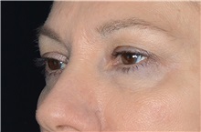 Eyelid Surgery Before Photo by Landon Pryor, MD, FACS; Rockford, IL - Case 38530