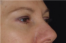 Eyelid Surgery After Photo by Landon Pryor, MD, FACS; Rockford, IL - Case 38530