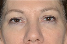 Eyelid Surgery Before Photo by Landon Pryor, MD, FACS; Rockford, IL - Case 38530