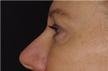 Eyelid Surgery After Photo by Landon Pryor, MD, FACS; Rockford, IL - Case 38530