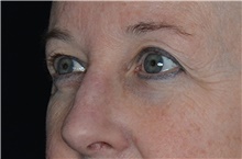 Eyelid Surgery Before Photo by Landon Pryor, MD, FACS; Rockford, IL - Case 38698