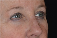 Eyelid Surgery After Photo by Landon Pryor, MD, FACS; Rockford, IL - Case 38698