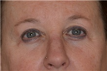Eyelid Surgery After Photo by Landon Pryor, MD, FACS; Rockford, IL - Case 38698