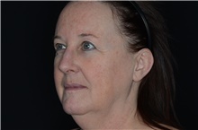 Injectable Fillers and Fat Transfer to the Face Before Photo by Landon Pryor, MD, FACS; Rockford, IL - Case 38701