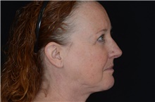 Injectable Fillers and Fat Transfer to the Face After Photo by Landon Pryor, MD, FACS; Rockford, IL - Case 38701