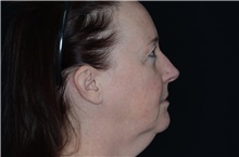 Injectable Fillers and Fat Transfer to the Face Before Photo by Landon Pryor, MD, FACS; Rockford, IL - Case 38701