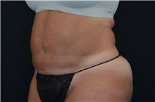 Liposuction After Photo by Landon Pryor, MD, FACS; Rockford, IL - Case 38702