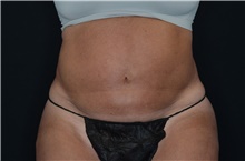 Liposuction After Photo by Landon Pryor, MD, FACS; Rockford, IL - Case 38702