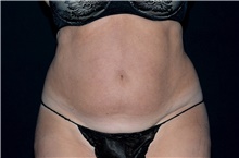 Liposuction Before Photo by Landon Pryor, MD, FACS; Rockford, IL - Case 38702