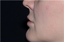 Lip Augmentation/Enhancement After Photo by Landon Pryor, MD, FACS; Rockford, IL - Case 38764