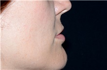 Lip Augmentation/Enhancement Before Photo by Landon Pryor, MD, FACS; Rockford, IL - Case 38764