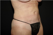 Liposuction After Photo by Landon Pryor, MD, FACS; Rockford, IL - Case 38765