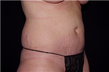 Liposuction Before Photo by Landon Pryor, MD, FACS; Rockford, IL - Case 38765