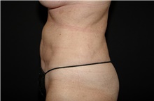 Liposuction After Photo by Landon Pryor, MD, FACS; Rockford, IL - Case 38765