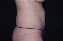 Liposuction Before Photo by Landon Pryor, MD, FACS; Rockford, IL - Case 38765