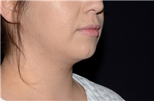 Liposuction After Photo by Landon Pryor, MD, FACS; Rockford, IL - Case 38766