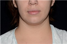 Liposuction Before Photo by Landon Pryor, MD, FACS; Rockford, IL - Case 38766