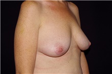 Breast Lift Before Photo by Landon Pryor, MD, FACS; Rockford, IL - Case 38767