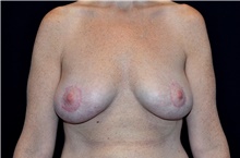Breast Lift After Photo by Landon Pryor, MD, FACS; Rockford, IL - Case 38767