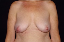 Breast Lift Before Photo by Landon Pryor, MD, FACS; Rockford, IL - Case 38767