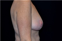 Breast Lift After Photo by Landon Pryor, MD, FACS; Rockford, IL - Case 38767