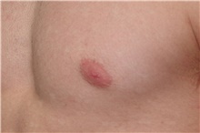 Male Breast Reduction Before Photo by Landon Pryor, MD, FACS; Rockford, IL - Case 38810